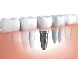 Image use for dental implants in dental spa- BEST DENTIST IN PATNA